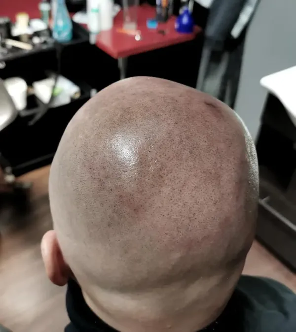 Mikropigmentácia: Revolučné Riešenie Plesatosti a Alopecie